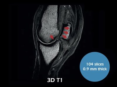 3D T1 sagitalna, artropatija fetloka